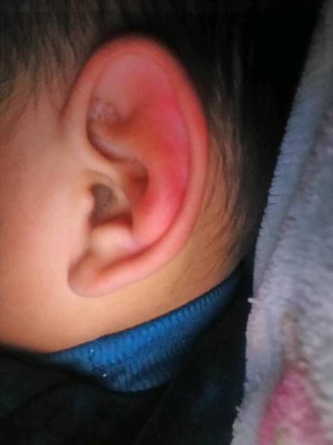 宝宝耳廓红肿怎么回事_宝宝两岁四个月了!昨天