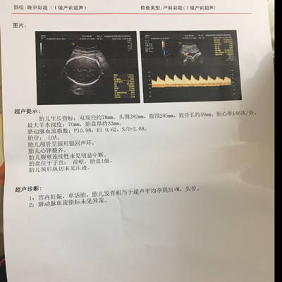 胎位loa是什麼意思啊?胎位正吗?还有羊水70正常吗?