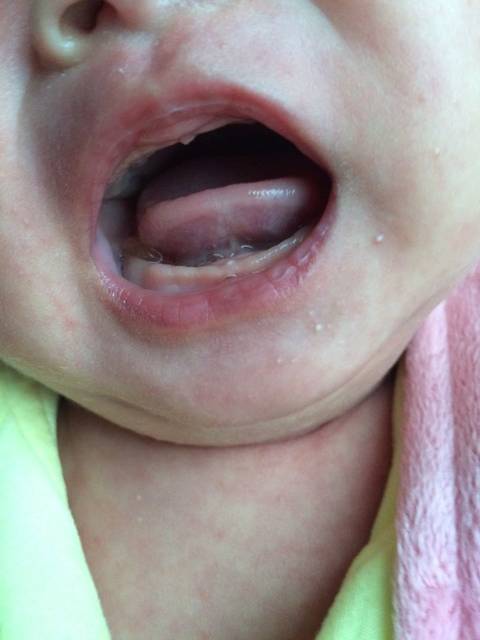 我家宝宝嘴里舌头下长了个肉肉的东西下面是图