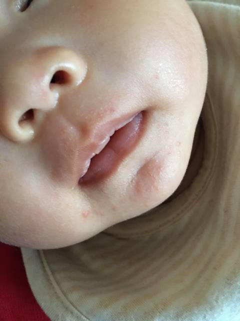 宝宝嘴巴周围红疹子