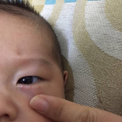 眼睛上长了小红疙瘩,怎么回事呢,宝宝3个半月