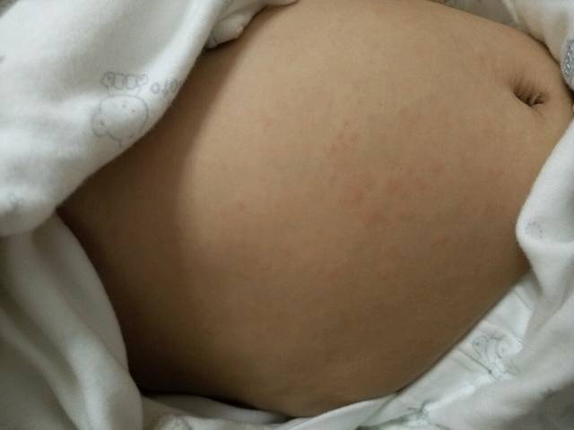 7个月宝宝发烧后身上长满红点点