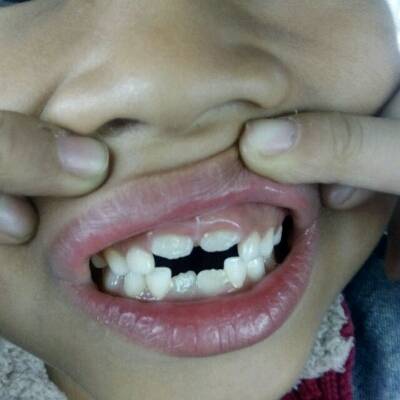 孩子6岁,换牙齿,门牙长成这个样子,分得很开,旁边的牙还没换,以后会不