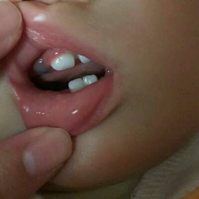 宝宝11个月,发现牙龈里面变黑,好像淤血状,请问是什么