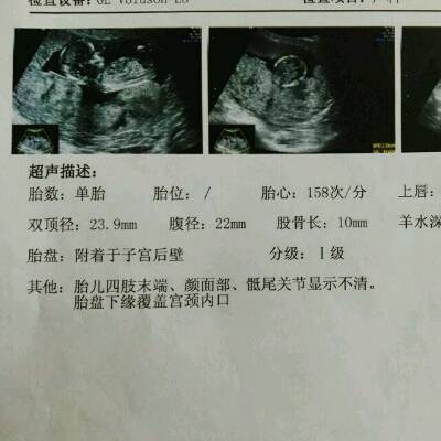 13周做的B超显示胎儿四肢末端,颜面部,骶骨关