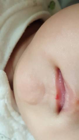 婴儿嘴唇血管瘤如何治疗