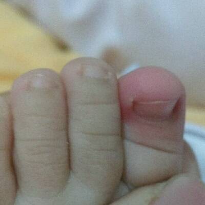 我家宝9个月了好像小脚丫的大脚趾头得了甲沟