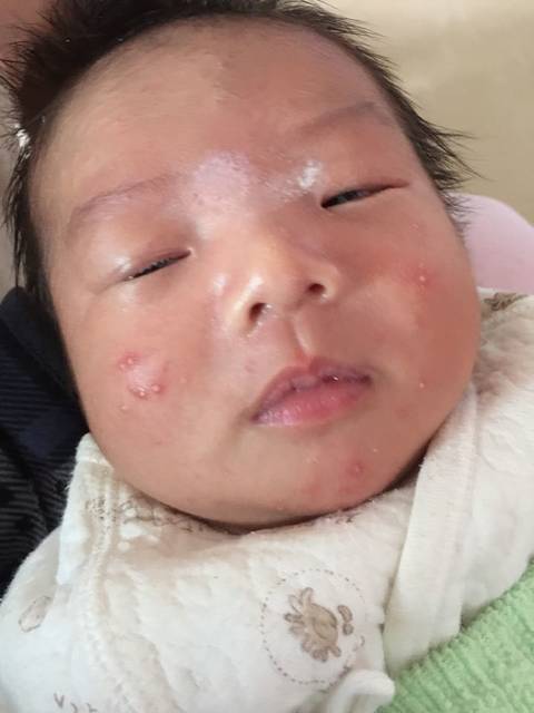 医生说是胎毒_有没有宝宝也像我宝宝这样的?