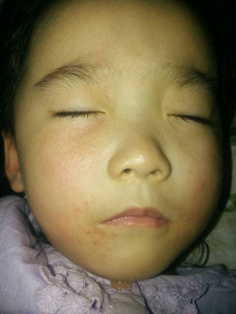 贝三岁,不明原因的脸上起了很多小米粒似的疙