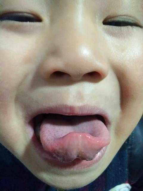 今天发现我儿子舌头有红点?不知道怎么回事?