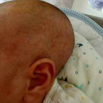宝宝今天29天,脸上长了湿疹,然后头上也长了痘