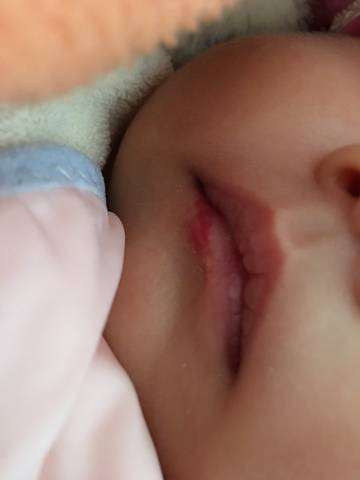 宝宝嘴唇上长了血管瘤怎么办_嘴唇上的血管瘤