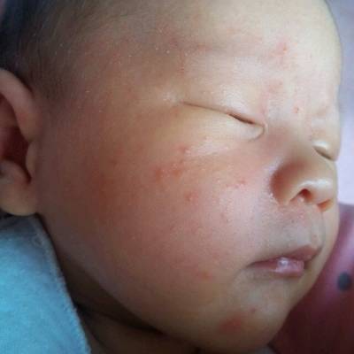 宝宝26天,母乳喂养,脸和头上出现一堆堆的小疙