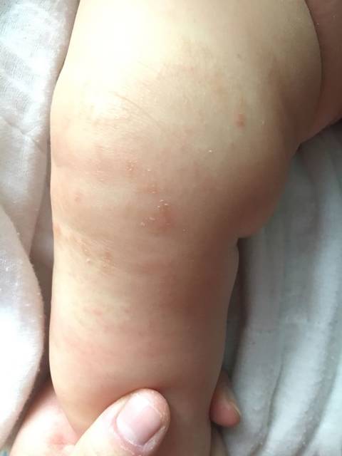 宝宝3个月,应该是干性湿疹(有图慎入)_宝宝从月
