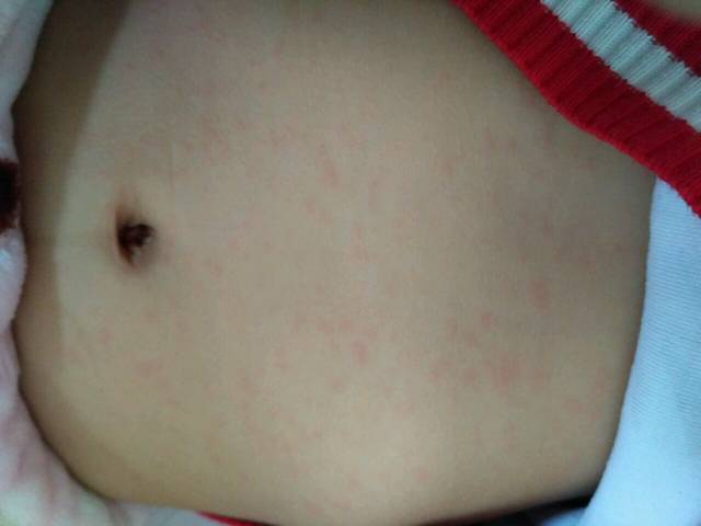 10个月宝宝身上有红色斑点是什么,宝妈们有谁