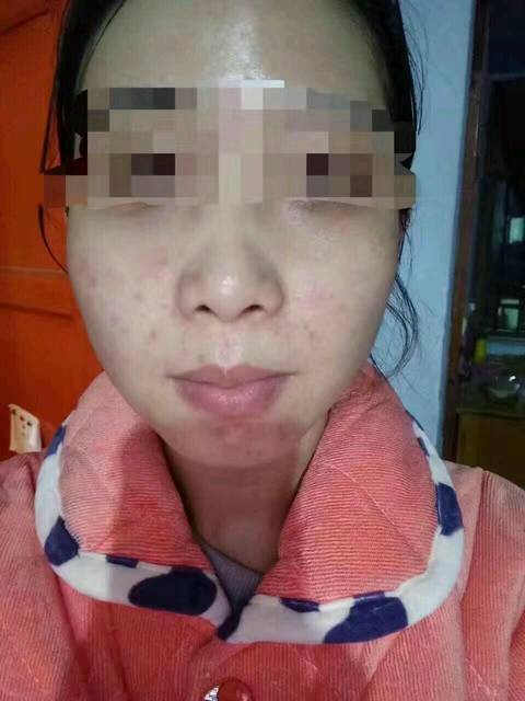 普及下激素脸,中国乱用化妆品的人太多了_激素