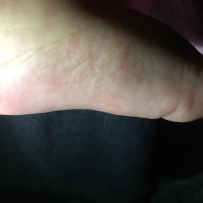 宝宝脚底长了很多红点,是湿疹吗?身上也有