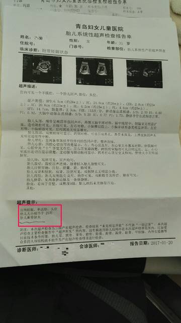 25周四维鼻骨缺失