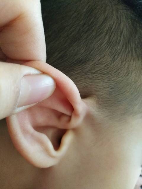 宝宝耳朵里有个小疙瘩_宝宝两岁半,近期发现耳