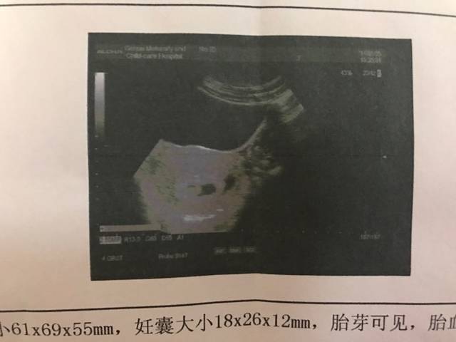 孕七周,见胎心胎芽叻!_孕四周整,见胎心胎芽了