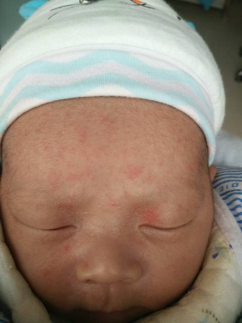 头痛啊!心疼啊!_宝宝脸上身上长了好多痘痘,擦