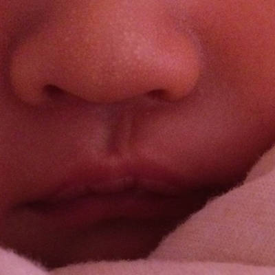 我心裏好难受 宝宝人中右边有道疤 和网上的唇裂照片很像 有懂的吗?