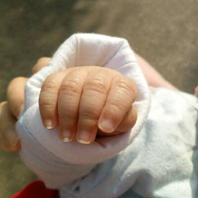宝宝有几个指甲这样凹进去怎么办?是不是身体