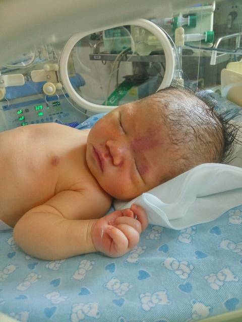 红斑痣吗?_宝宝一出生就有了,额头和眼皮上,能