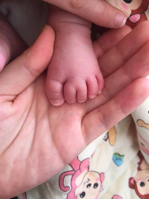 宝宝并趾_发现宝宝右脚第二和第三脚趾头没有