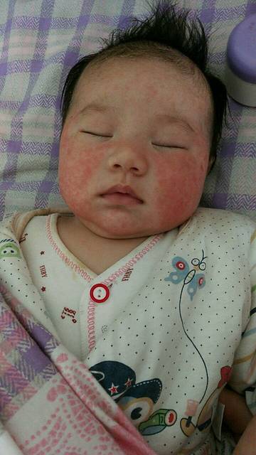 过敏,湿疹怎么办_宝宝两个月,湿疹少量,用了紫