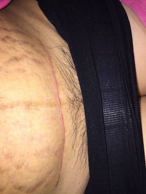 剖腹产伤口增生,大家看看严重不_伤口增生了。