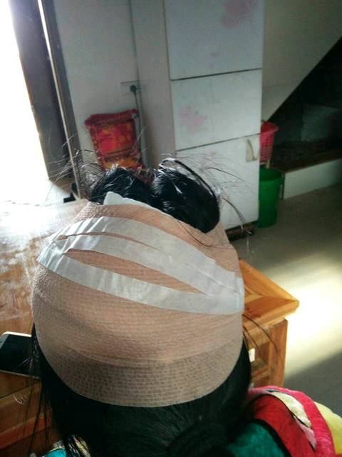 怀孕头被3楼顶水泥块掉下来打破。_孕妇18周