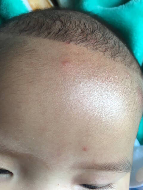 宝宝总爱出红点_我家宝宝4个月24天了,最近脸