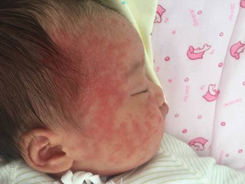 新生儿痤疮_宝宝出院没几天脸上起了小红疙瘩
