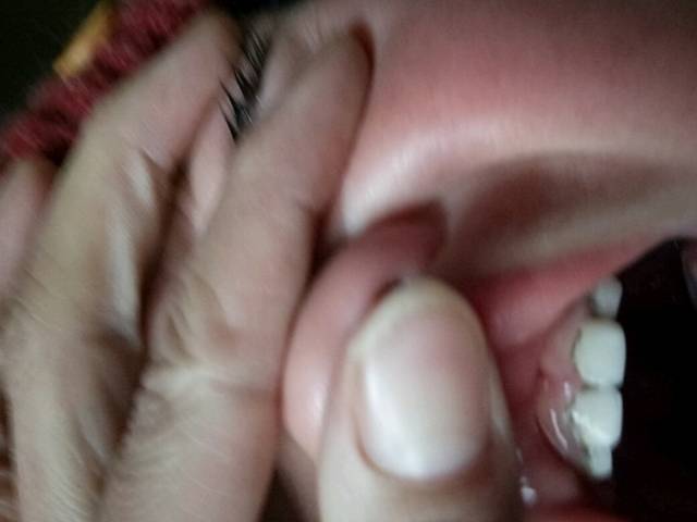 宝贝牙齿_我的宝贝一岁半了,上面的门牙牙根部