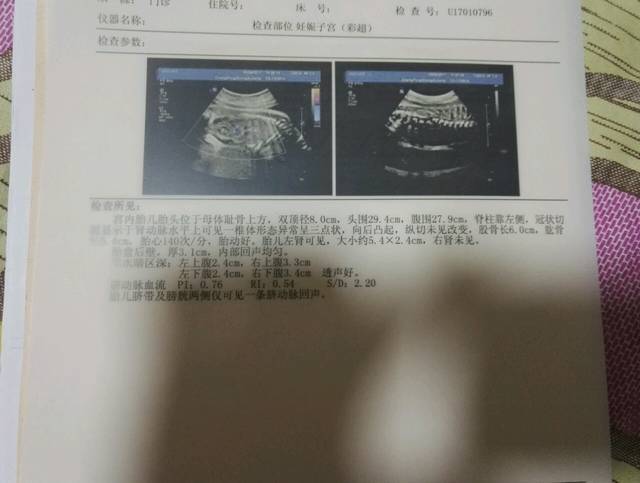 二次筛查排畸查出宝宝只有单肾,脊椎向后凸起