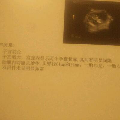 怀孕十二周,双胎,双孕囊双绒毛双羊膜,其中一胎停育,另一个发育正常头