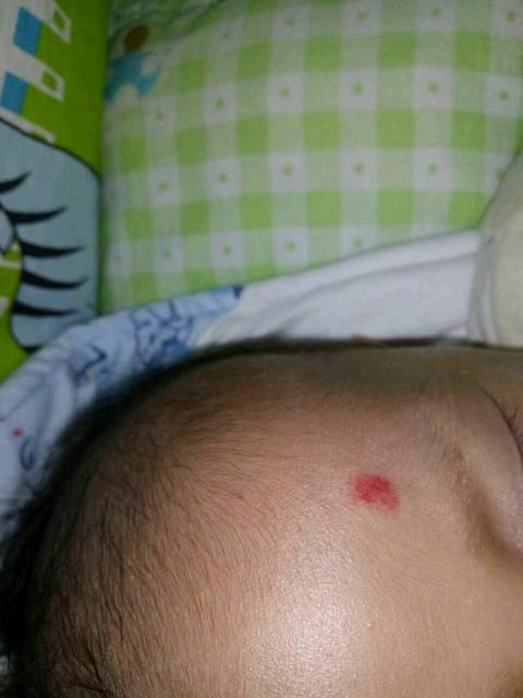 婴儿血管瘤早期症有哪些?_血管瘤的症状很狡