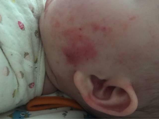 宝宝湿疹(带图)_宝宝脸上湿疹有什么好办法?痒