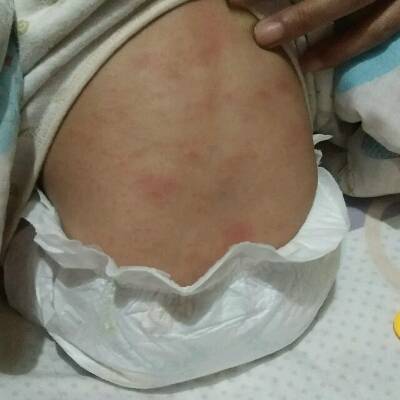 最近感冒咳嗽, 昨晚背部又有红疹子是怎么了