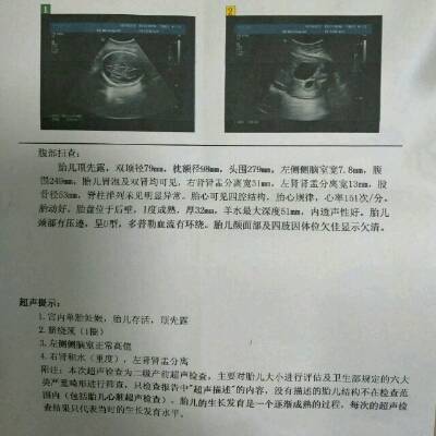 你好医生,我怀孕七个月时做b超,显示胎儿左肾