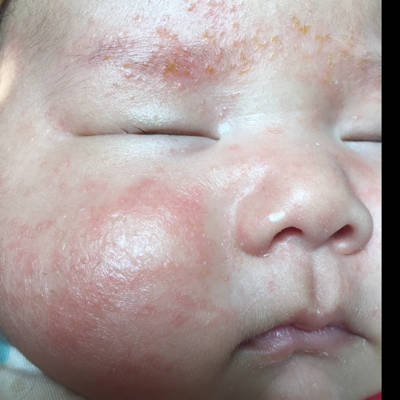 宝宝的脸是湿疹吗?,怎么皮肤还皱巴巴的掉皮怎