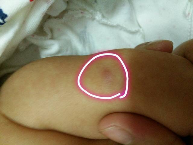 手臂上长了像逗一样的是什么?_手臂上长了个