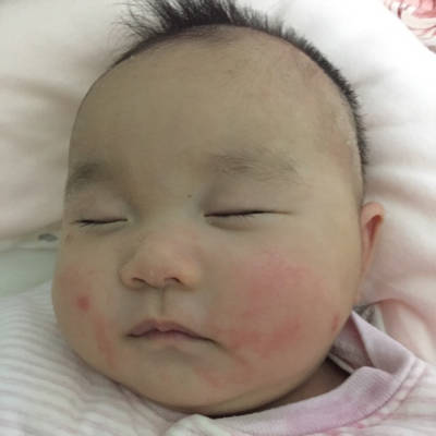 宝宝总是反反复复脸一片红一片红的,这是湿疹