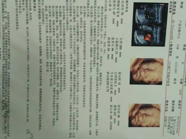 四维彩超结果染色体异常标志