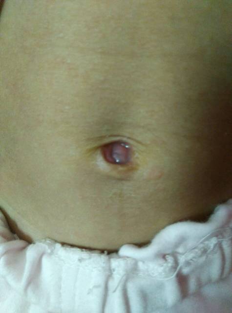 宝宝肚脐眼发红流水