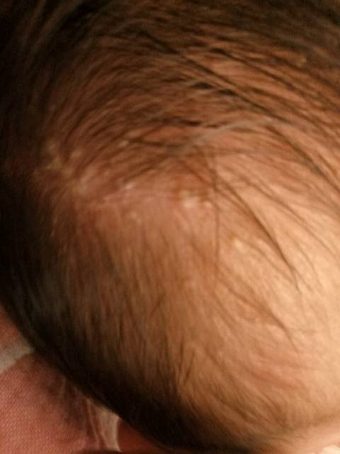 宝宝一个月了,头上起了像小水泡样的白疙瘩,是