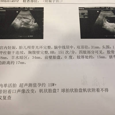 怀孕15周做B超检查说疑似帆状胎盘,这种胎盘