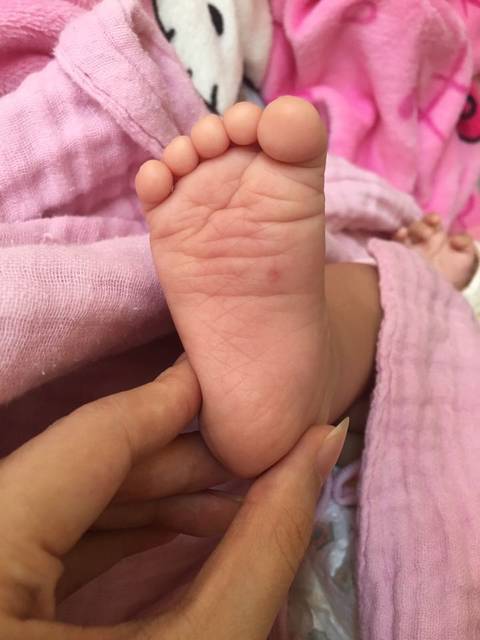 宝宝脚上长红点是什么?