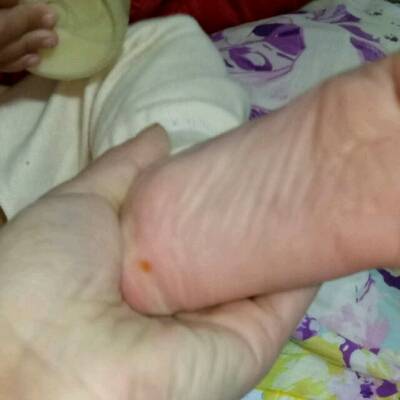 宝宝的脚底有一块皮肤黄色,不知道怎么了